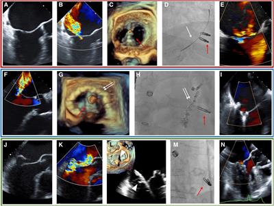 Outcomes of COMBO therapy for severe mitral regurgitation compared with transcatheter edge-to-edge repair